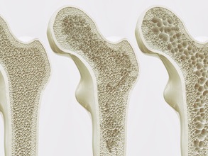 Osteoporose: Symptome und Behandlung